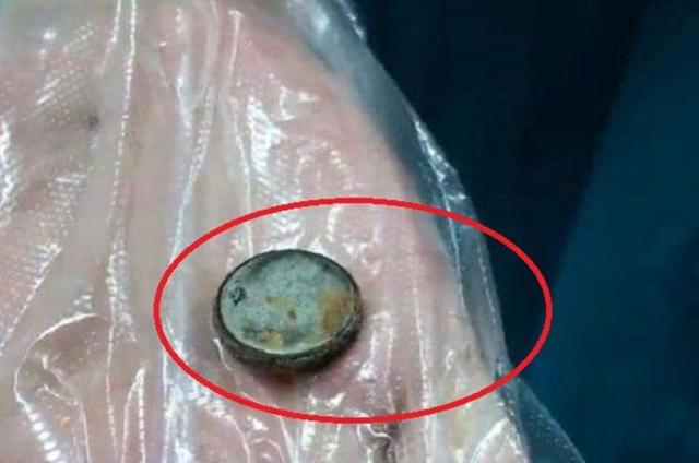 误吞电池致终身残疾误吞电池，一生难以抹去的伤痛